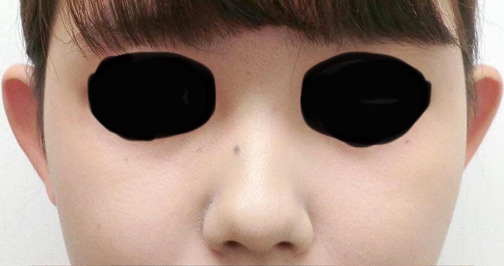 みずほクリニックで耳・耳たぶの整形：立ち耳整形（立ち耳にする整形術）を受けたさんさんの写真