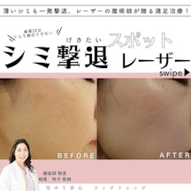 【女性・シミ】ピコスポット_before_aftar