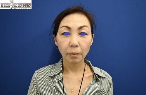 【52歳女性・輪郭】SBCプレミアムPRP皮膚再生療法、目の下の切らないクマ・たるみ（ふくらみ）取り_1month