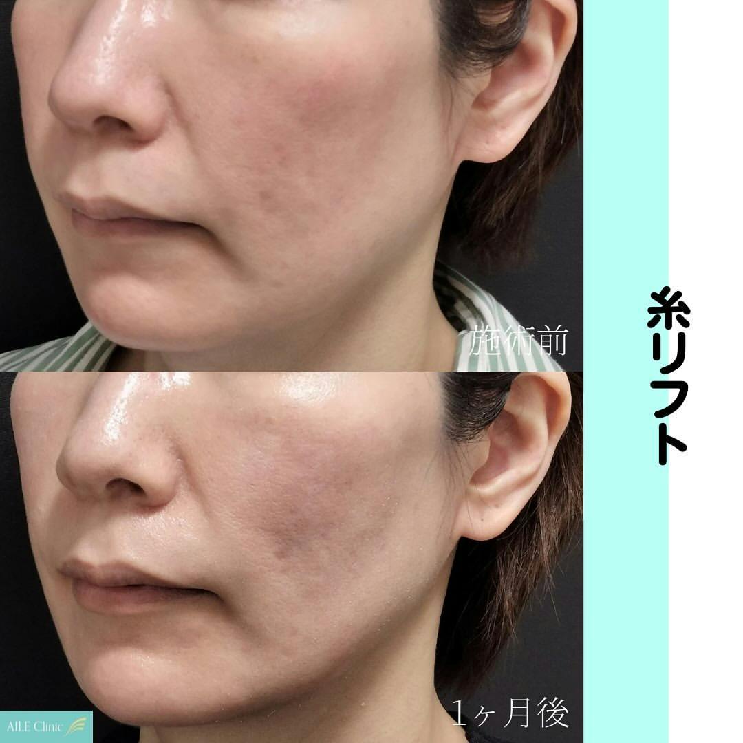 【女性・小顔】糸リフト_before_aftar