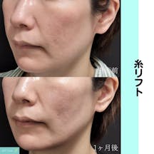 【女性・小顔】糸リフト_before_aftar