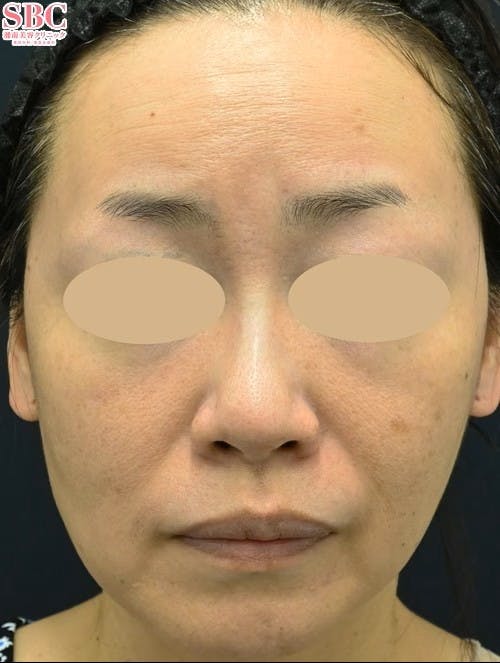 【女性・肌】シルファームX_aftar