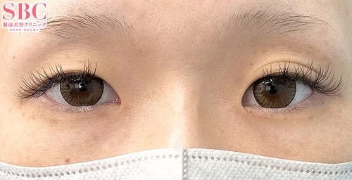 【女性・目元】クイックコスメティーク・ダブルNeo、目頭切開プレミアム、MD式切開法_before