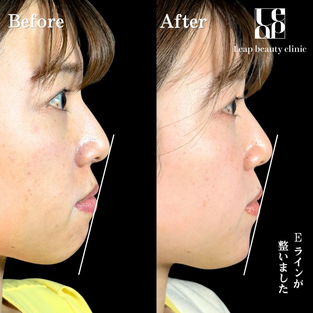 【女性・顎】あごヒアルロン酸・ボトックス_before_aftar