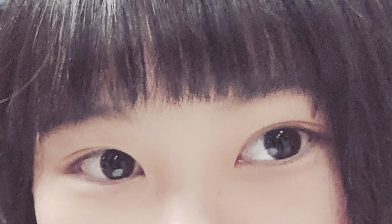 湘南美容クリニック 名古屋駅本院で二重埋没法を受けたあいさんの写真