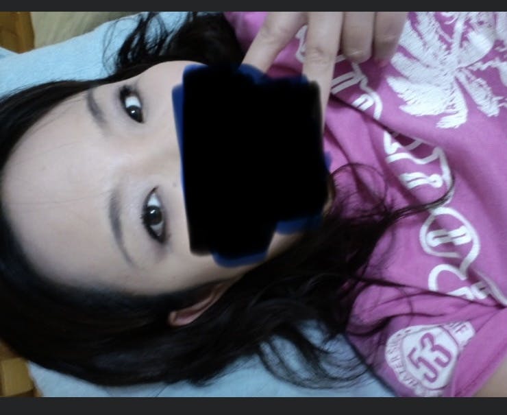 品川美容外科 池袋院でを受けたレイさんの写真