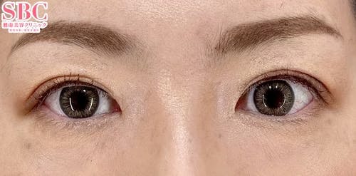 【40代女性・目元】週末二重(R)_aftar