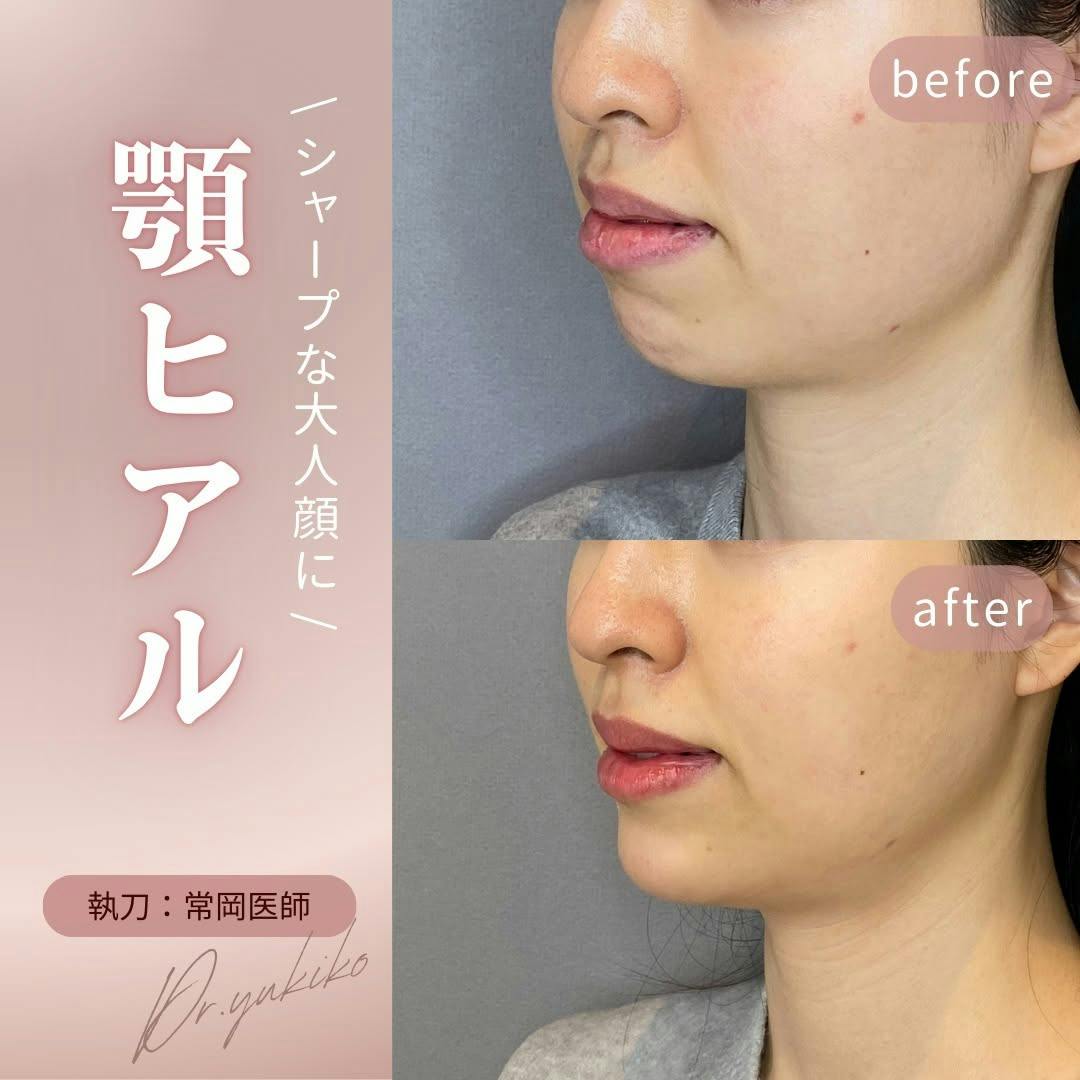 【女性・顎】ヒアルロン酸注入_before_aftar