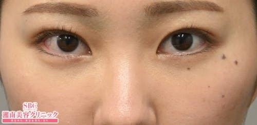 【20代女性・目元】目の下の切らないクマ・たるみ（ふくらみ）取り ナチュラル脂肪注射コンデンスリッチ ナチュラル脂肪注射ナノリッチ_after