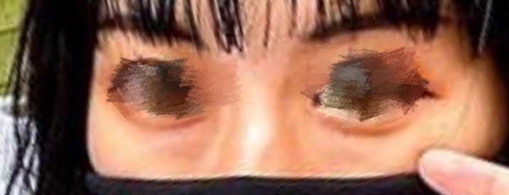 東京形成美容外科 船橋院で目の下のクマ・たるみ取りを受けたTiさんの写真