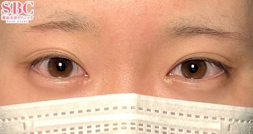 【10代女性・目元】線留めクロス二重術_before