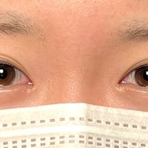 【10代女性・目元】線留めクロス二重術_before