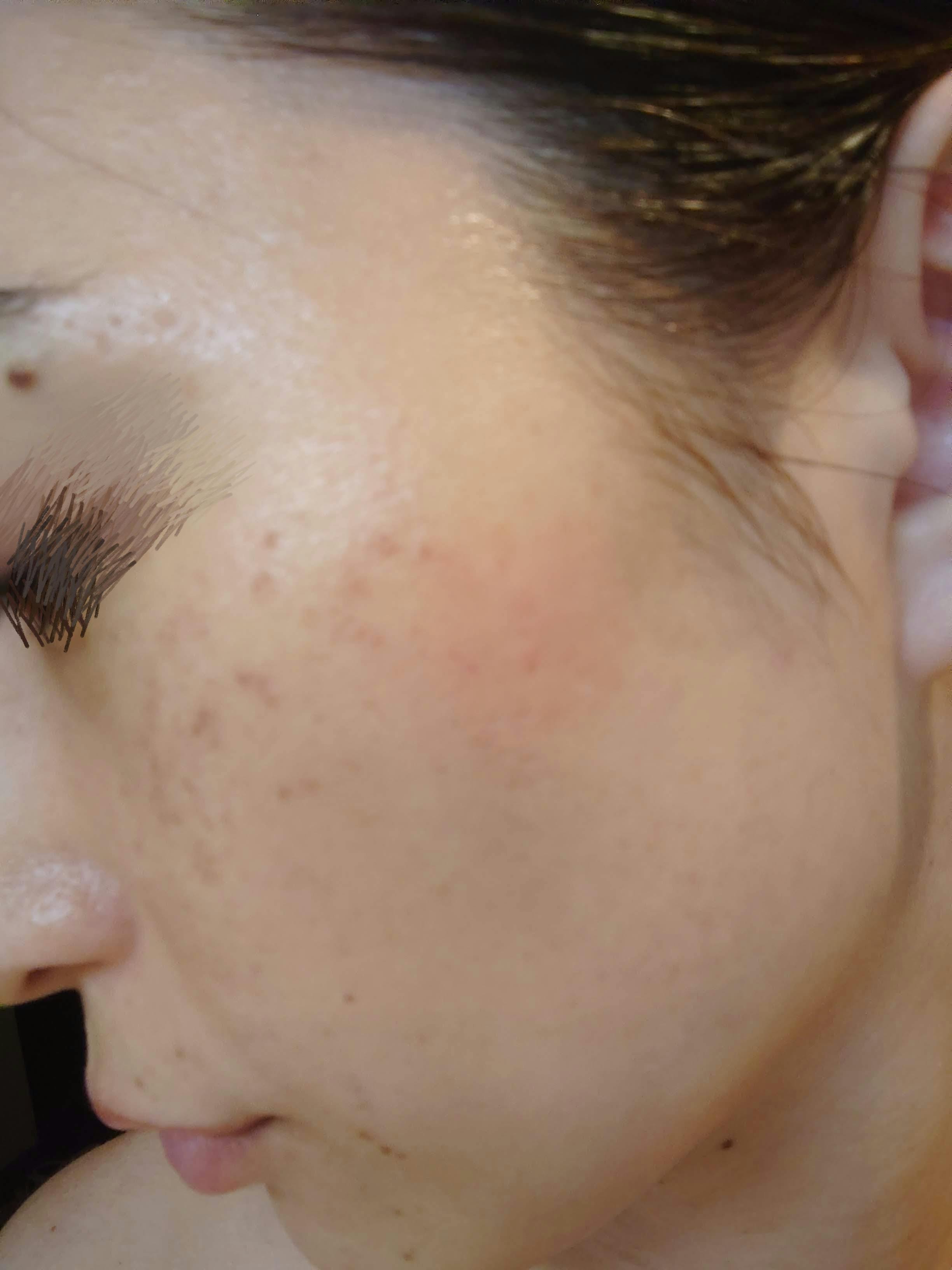 あやクリニックでIPL光治療(フォトフェイシャル)を受けたハッピーさんの写真