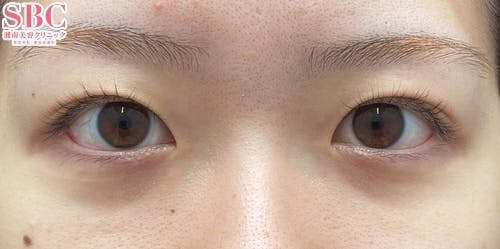 【女性・目元】タルミ取り併用全切開法二重 目頭切開プレミアム 目尻切開法_before