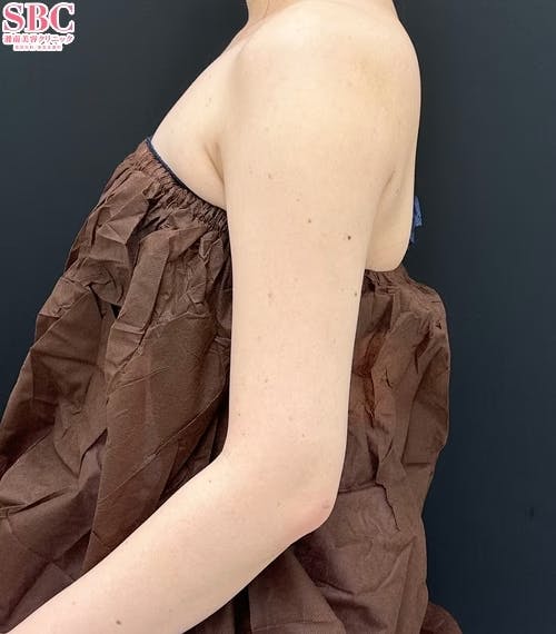 【女性・二の腕】Aquicell(アキーセル)脂肪吸引・根こそぎVASER脂肪吸引_after