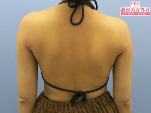 【女性・肩】ライポマティック脂肪吸引・根こそぎVASER脂肪吸引_aftar