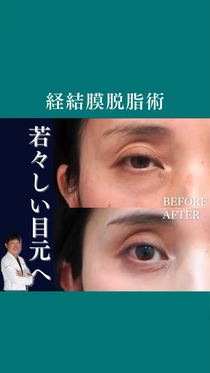 【目元】経結膜脱脂術・眼窩脂肪注入術_before_aftar