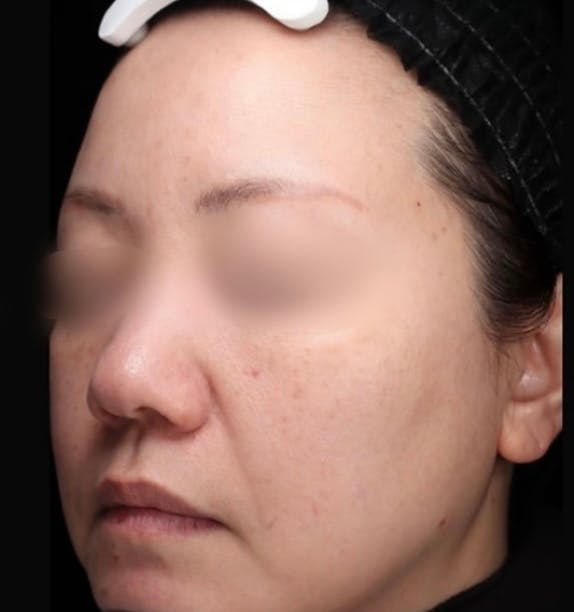 【女性・赤ら顔】メソナj_a1