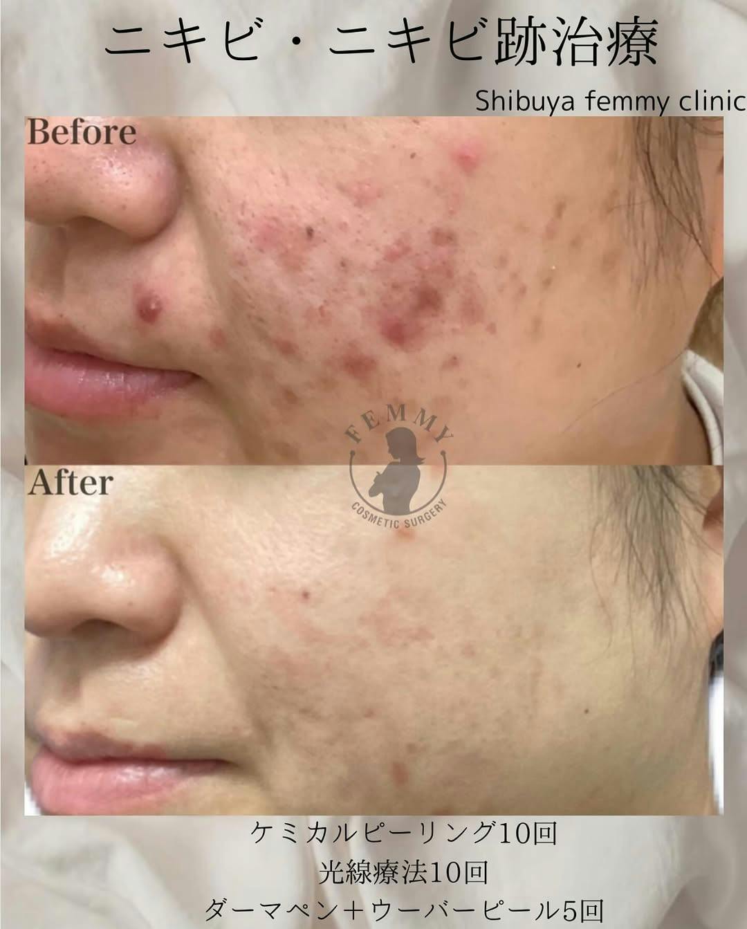 【ニキビ】ケミカルピーリング・光線療法・ダーマペンウーバーピール_before_aftar