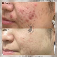 【ニキビ】ケミカルピーリング・光線療法・ダーマペンウーバーピール_before_aftar
