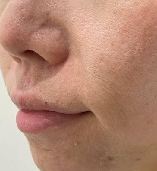 よつば会クリニック 有楽町院で毛穴・ニキビ痕の凹凸:ハイドラジェントル全顔を受けたマグマ会のみっちゃんさんの写真