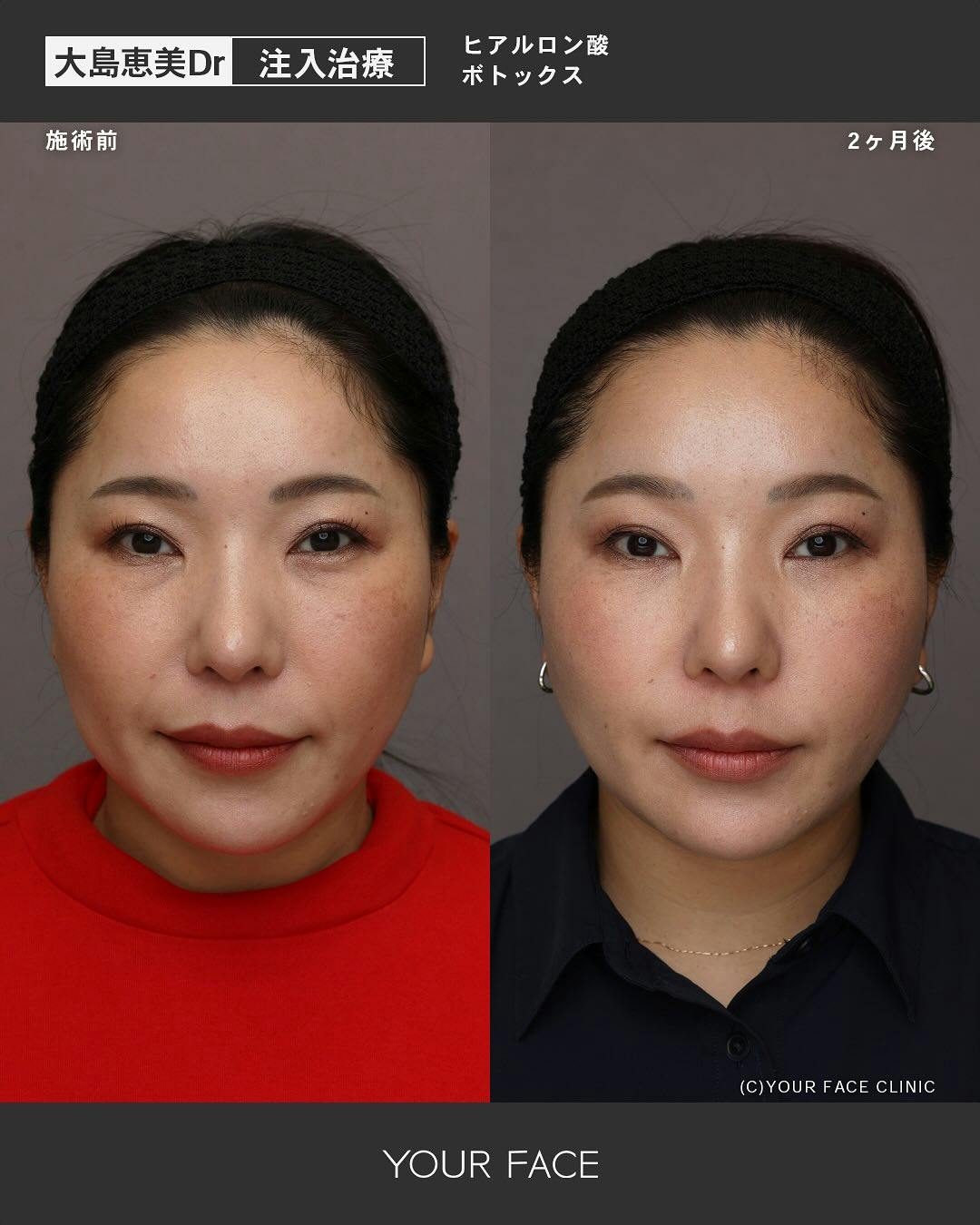【女性・輪郭】ヒアルロン酸 ボトックス _before_aftar