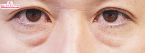【たるみ】目の下の切らないクマ・たるみ（ふくらみ）取り、切開ハムラ(表ハムラ)法、裏ハムラ法_before