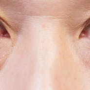 【たるみ】目の下の切らないクマ・たるみ(ふくらみ)取り、切開ハムラ(表ハムラ)法、裏ハムラ法_before