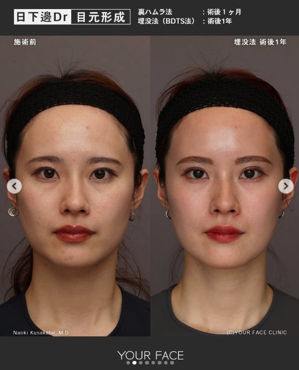 【女性・目元】埋没法（BDTS法）_before_aftar