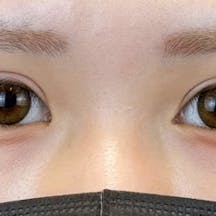【女性・目元】眼瞼下垂 タルミ取り併用全切開法二重 目尻切開法_aftar