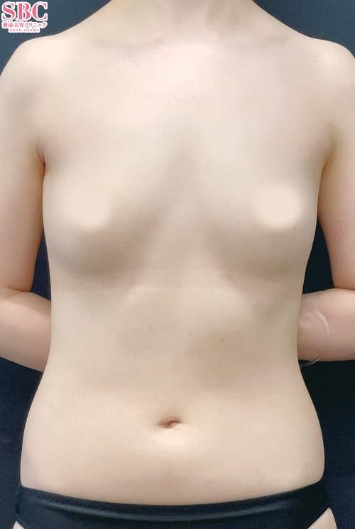 【女性・胸】Aquicell（アキーセル）併用セルーション(脂肪注入豊胸)・セルーション(脂肪注入豊胸)_before