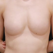 【20代女性・胸】Motivaエルゴノミックス2(バッグ豊胸)、内視鏡下バッグ豊胸_before