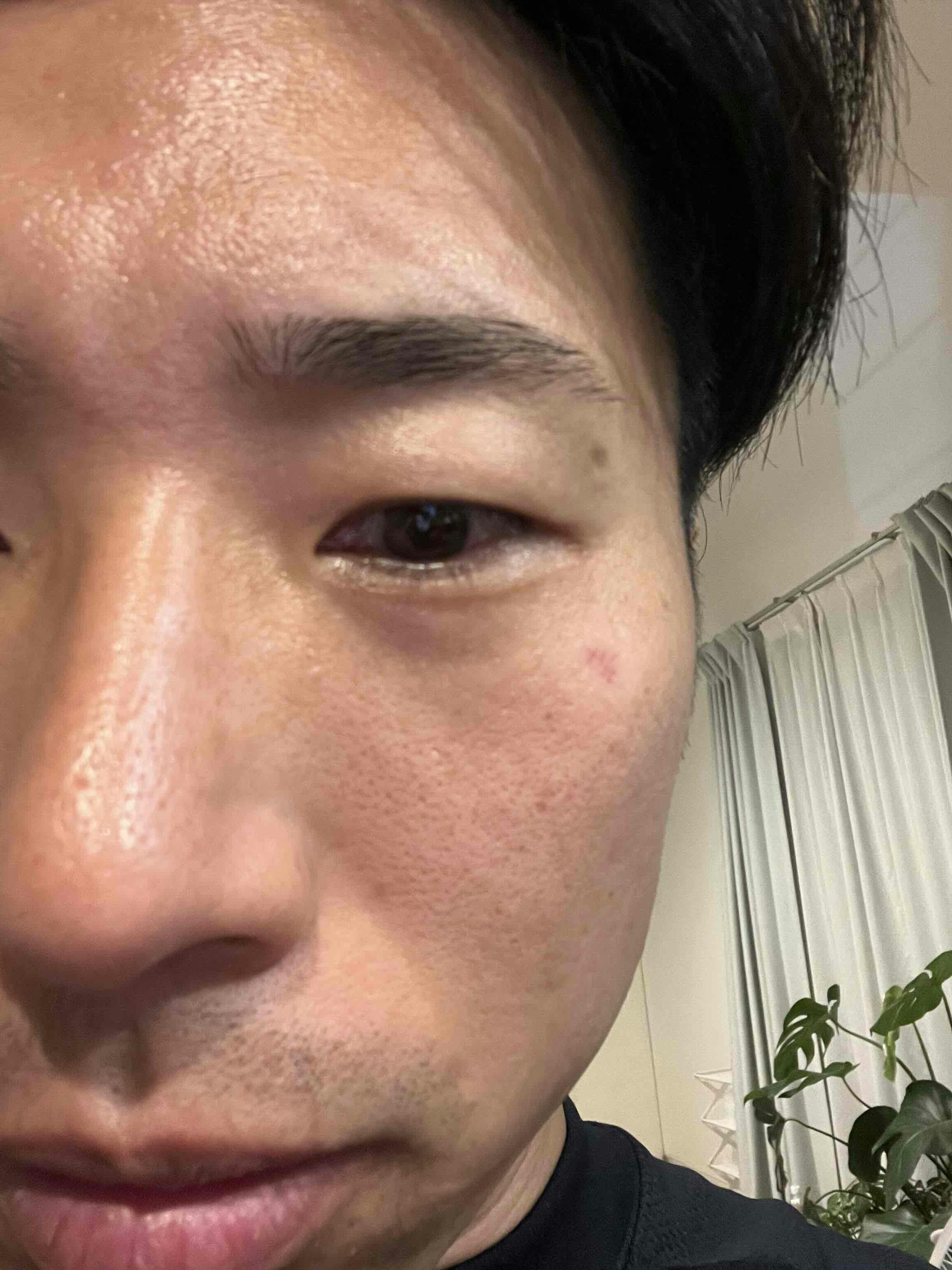 とくやま まぶた・スキン クリニックでホクロ除去：皮膚、皮下腫瘍摘出術を受けたとびさんの写真