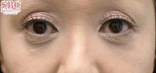 【女性・目元】目の下の切らないクマ・たるみ（ふくらみ）取り、ナチュラル脂肪注射コンデンスリッチ、ナチュラル脂肪注射ナノリッチ_aftar