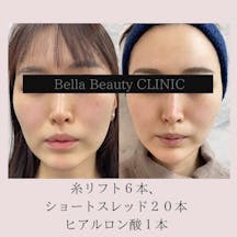 【女性・たるみ】糸リフト(フェイスライン)_before_aftar