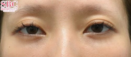 【女性・目元】目の下の切らないクマ・たるみ（ふくらみ）取り、ナチュラル脂肪注射コンデンスリッチ_1month