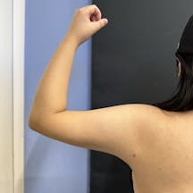 【女性・二の腕】美ボディ脂肪吸引_aftar