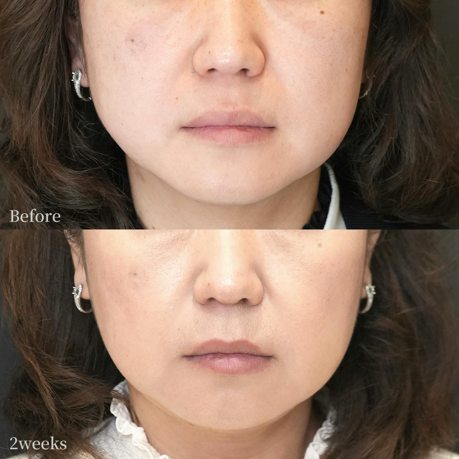 オンダリフトBEFORE_AFTER