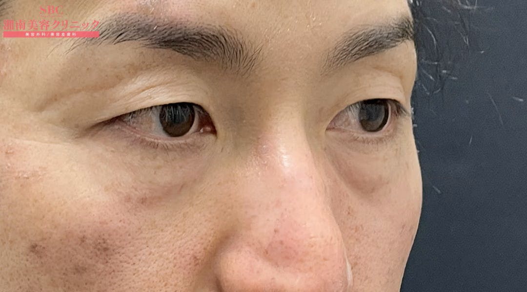 【40代男性・目元】目の下の切らないクマ・たるみ（ふくらみ）取り ナチュラル脂肪注射コンデンスリッチ ナチュラル脂肪注射ナノリッチ_before