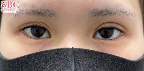 【女性・目元】眼瞼下垂 タルミ取り併用全切開法二重 目尻切開法_before