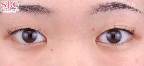 【20代女性・目元】クイックコスメティーク・トリプルNeo_before