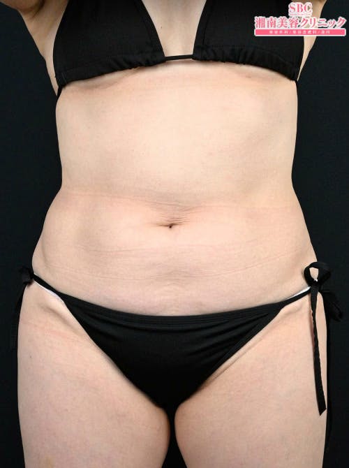 【50代女性・腹部】ダイエット注射 MITI（マイティ）_before