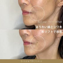 【女性・シワ】糸リフト(PDO)・スマイルラインスレッド_before_aftar