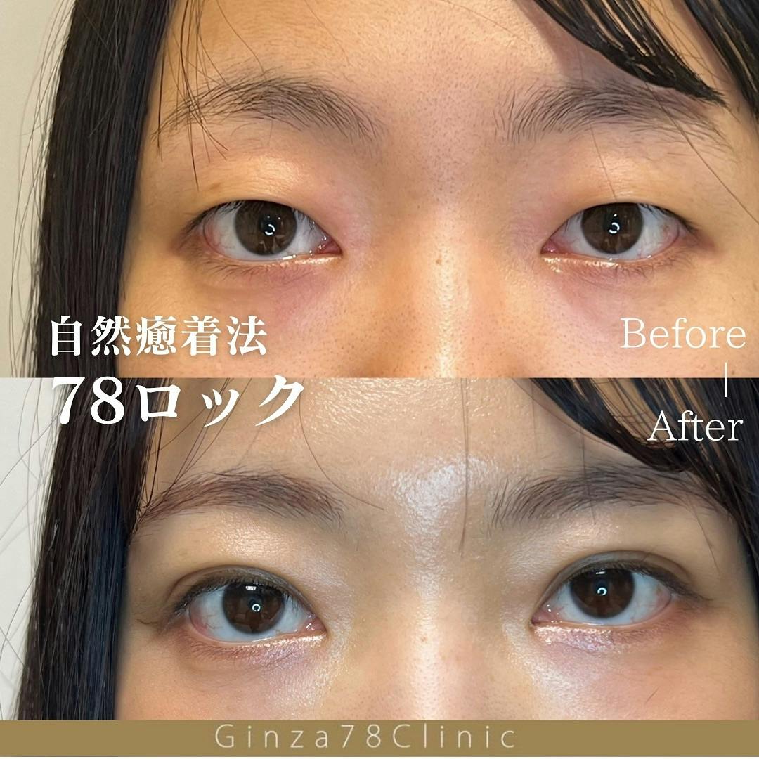【女性・目元】二重整形（78ロック法）_before_aftar