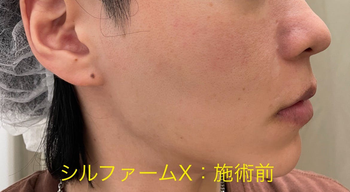 湘南美容クリニック 新宿本院でシルファームX・RF治療を受けたゆうち｜Yuchiさんの写真