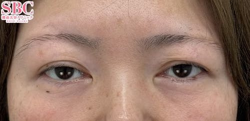 【40代女性・目元】眉下リフト（眉下切開）_before