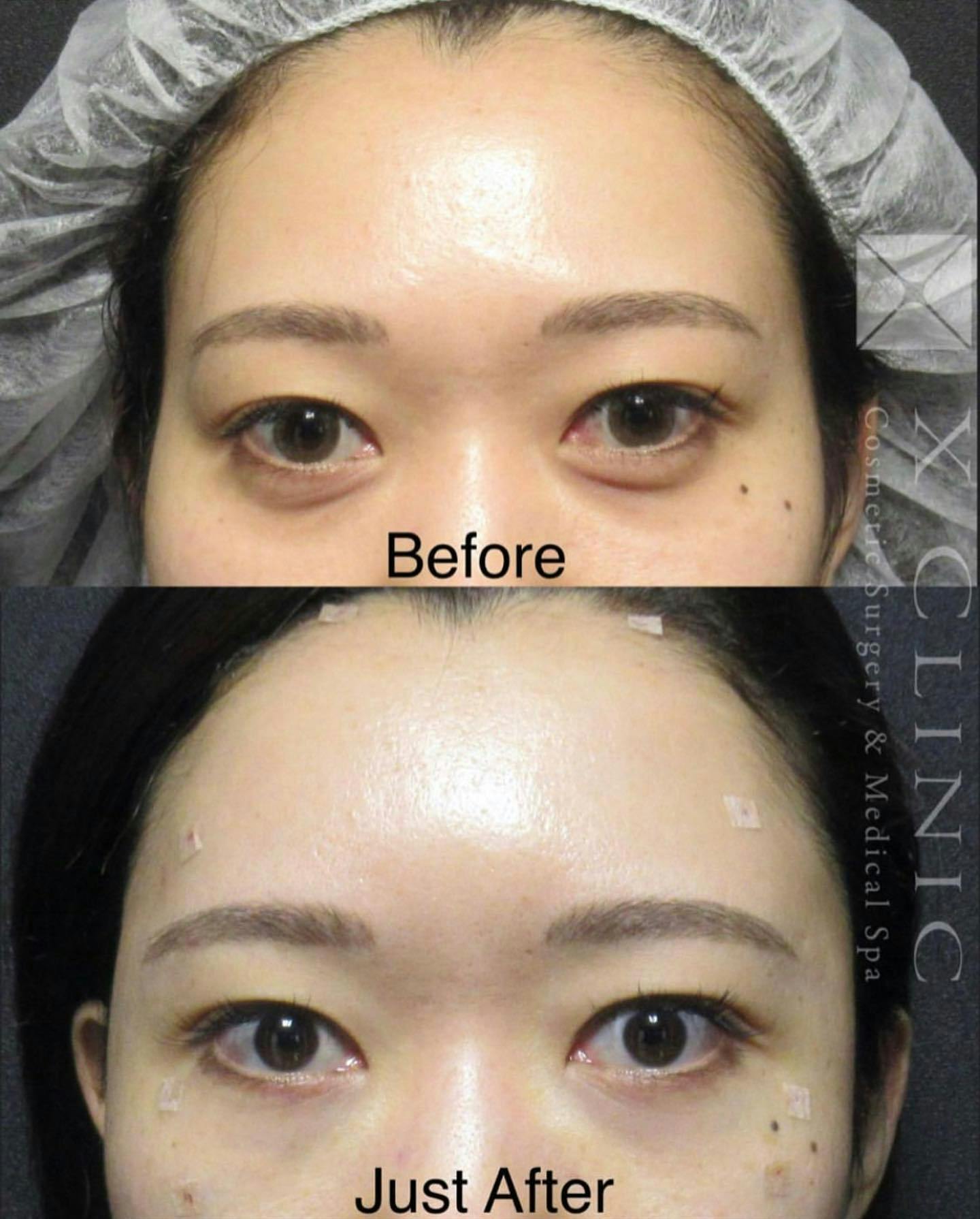 【女性・目元】クマ取りフルコース 額こめかみ脂肪注入_before_aftar