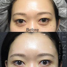 【女性・目元】クマ取りフルコース 額こめかみ脂肪注入_before_aftar