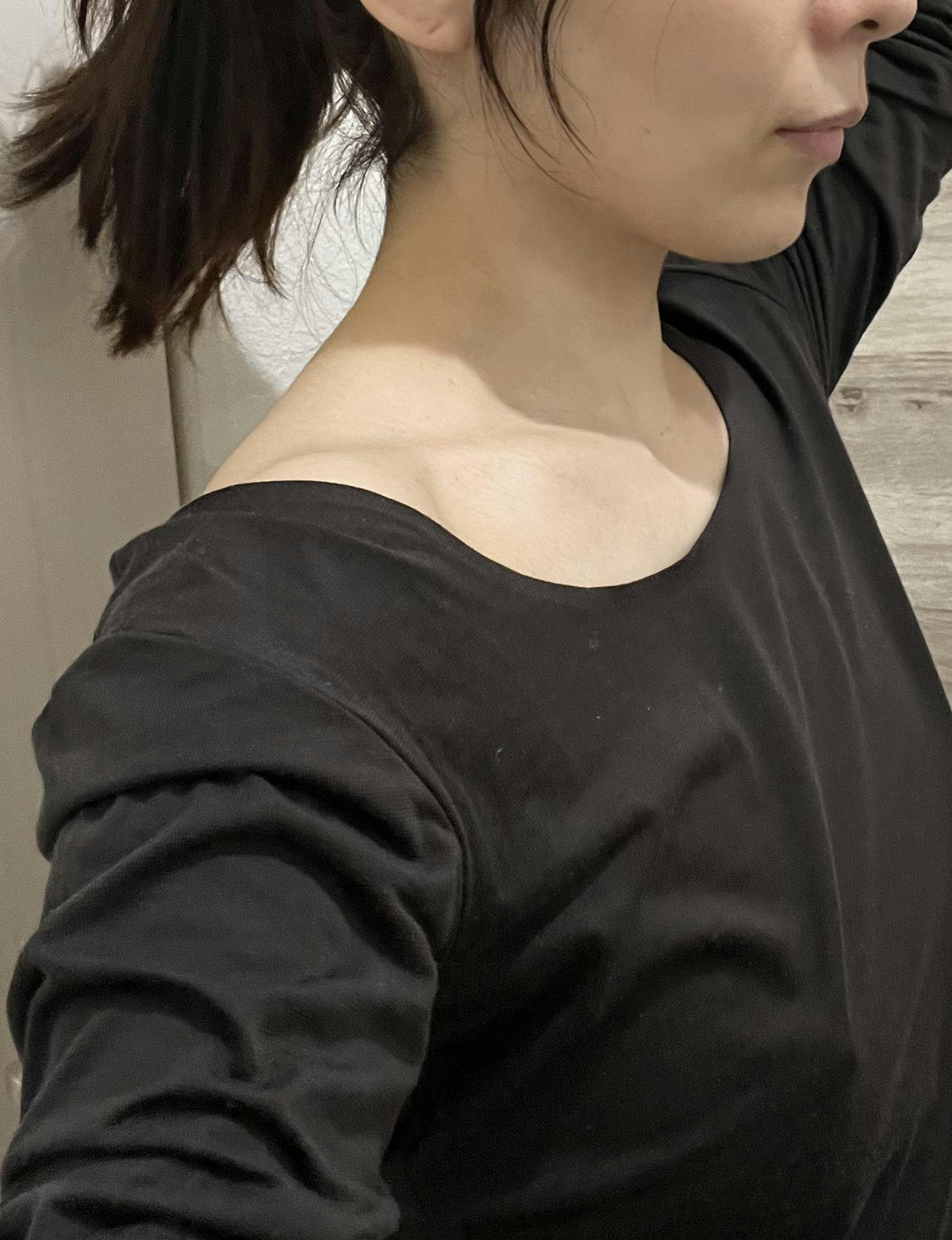 アンリクリニック 名古屋院(Henri Clinic)で肩ボトックスを受けたayaさんの写真
