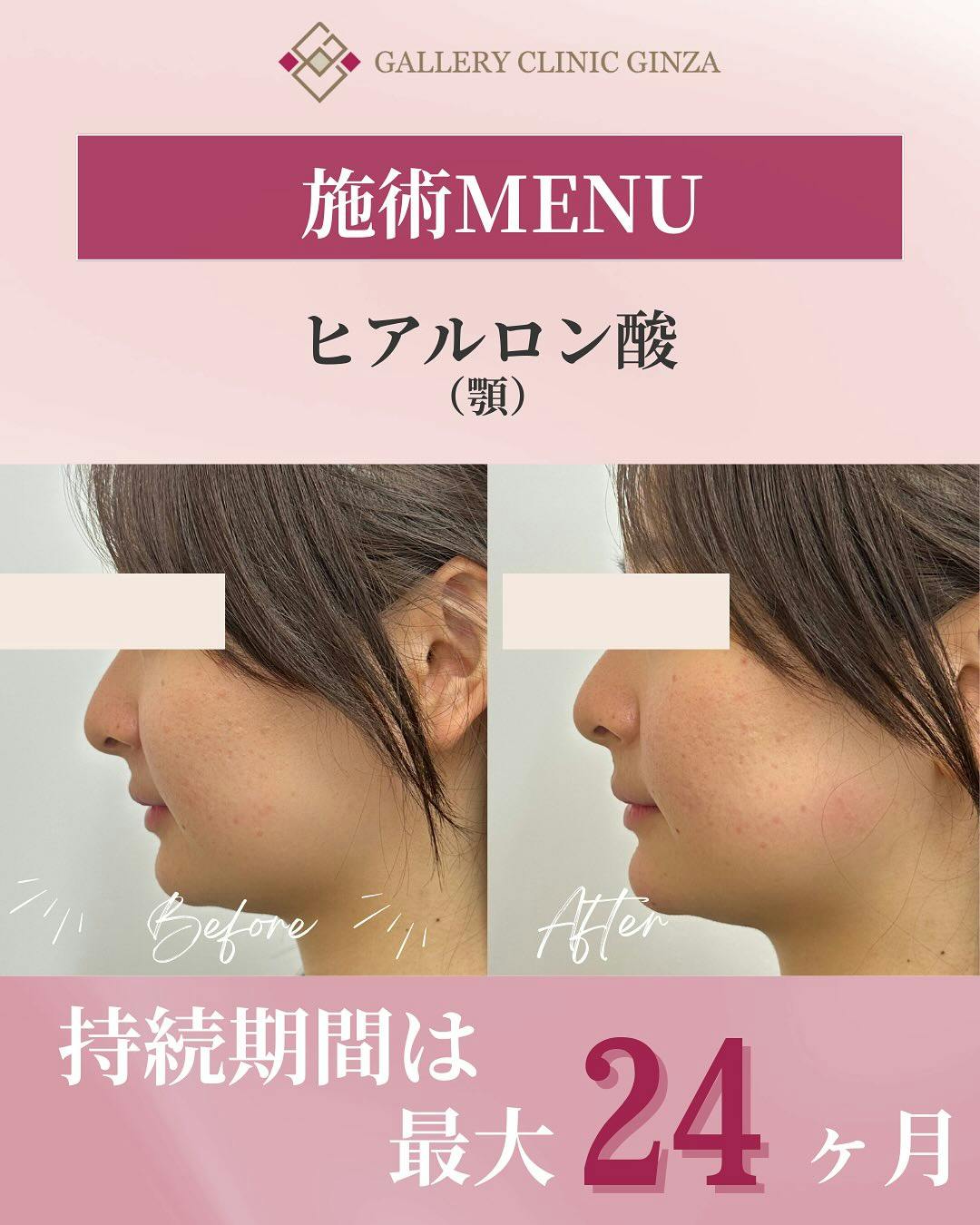 【女性・輪郭】ヒアルロン酸(あご)_before_aftar